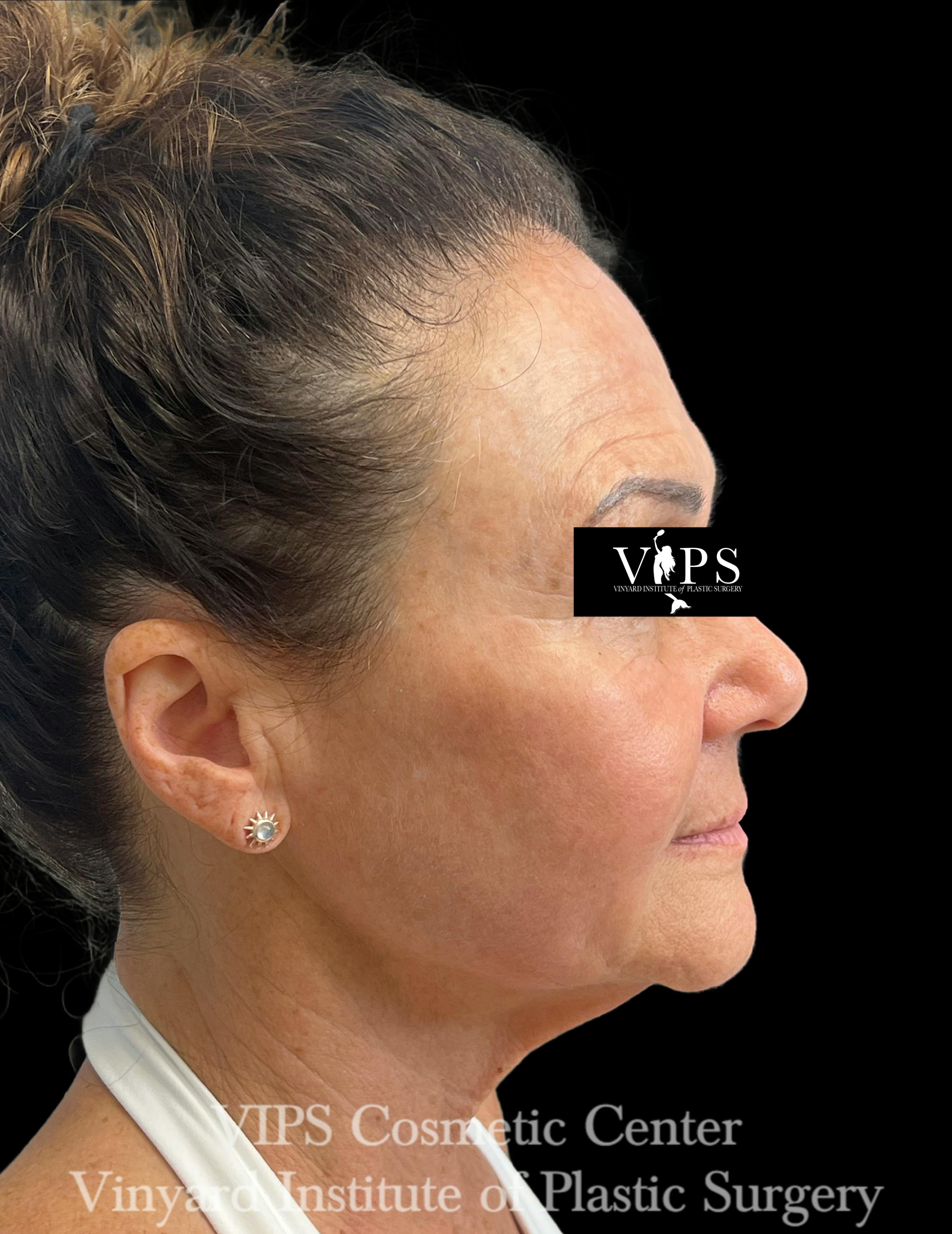 skin brightening