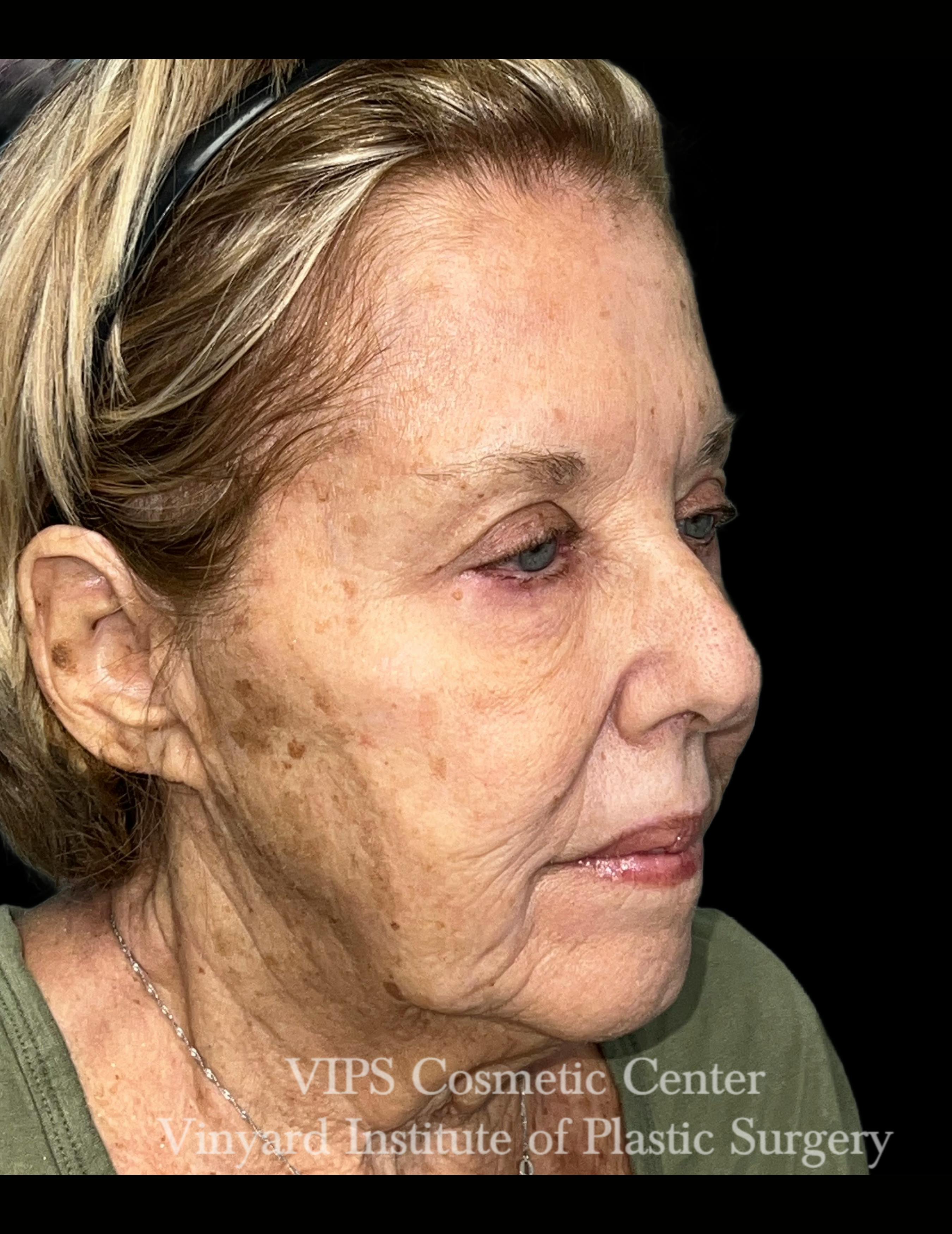 skin brightening