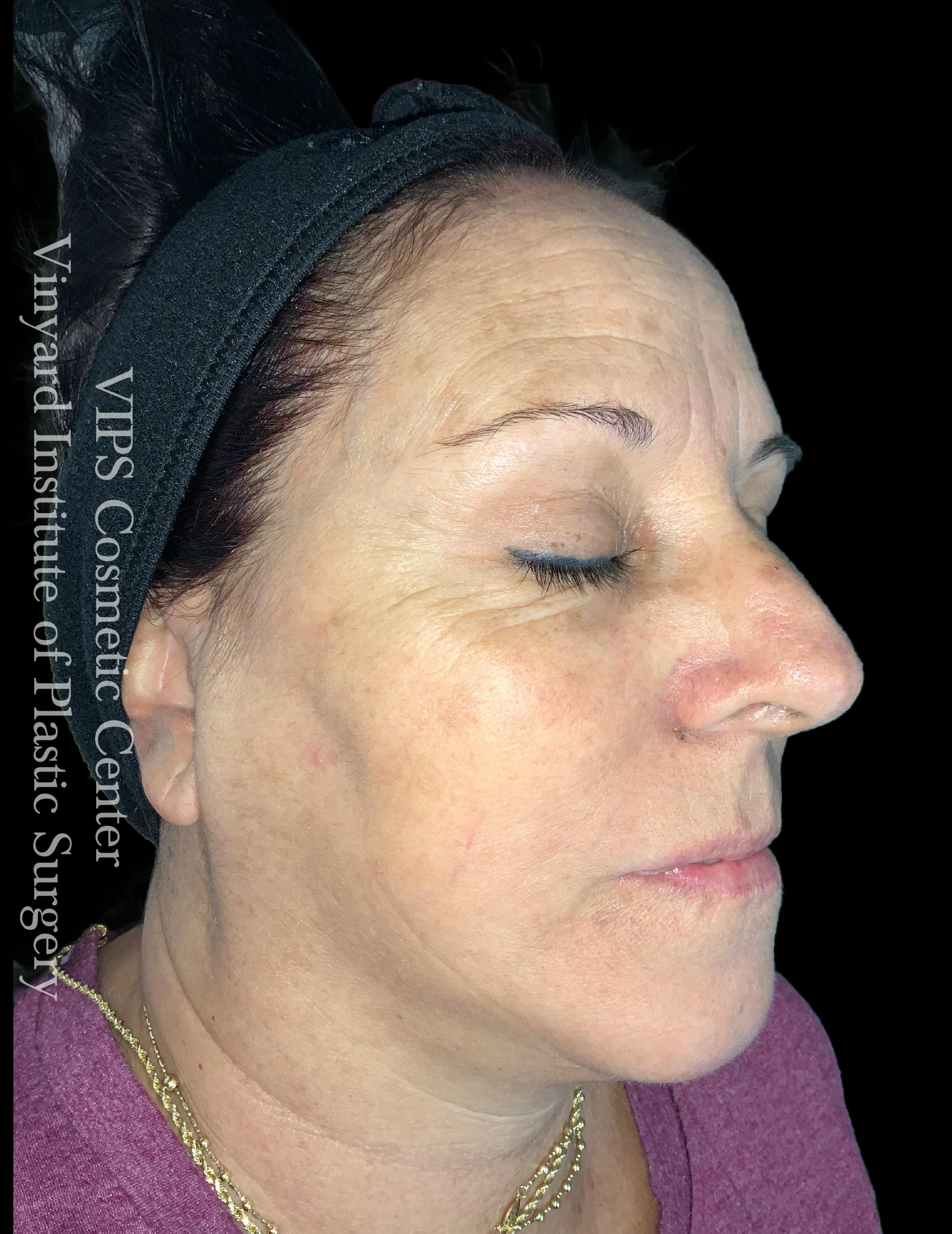 skin brightening