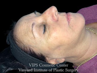 ELLUMINATE WITH IPL Before & After Gallery - Patient 304431 - Image 4