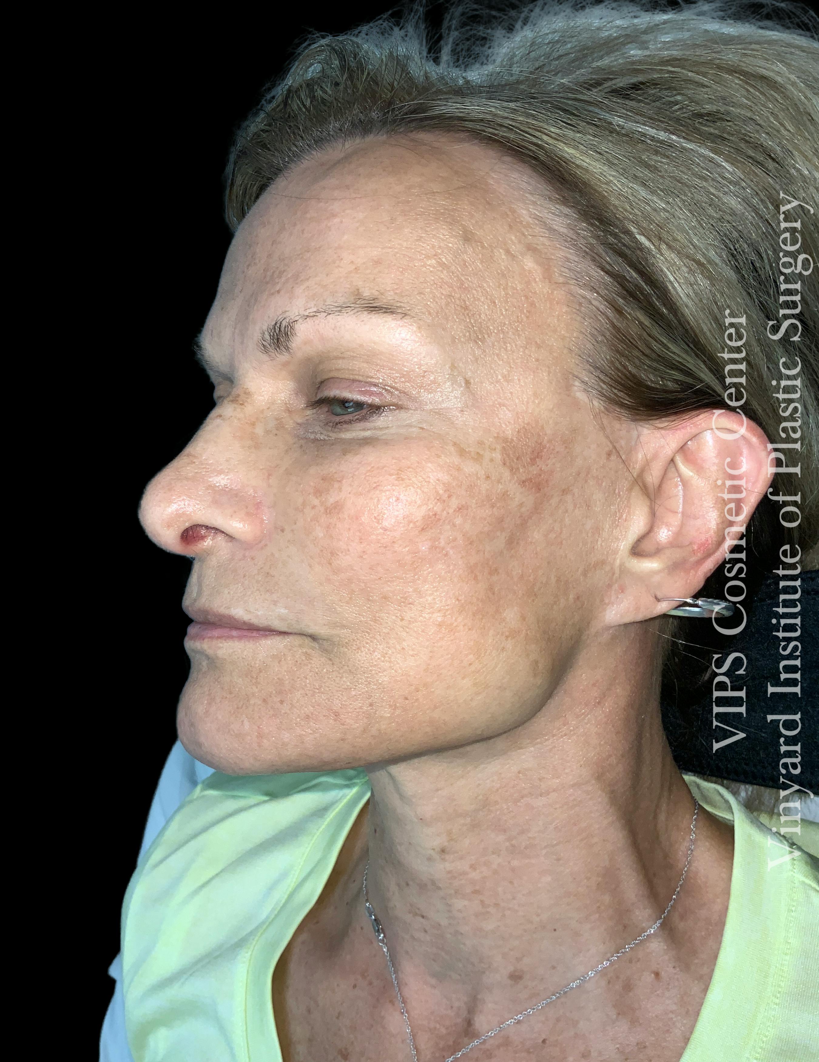 skin brightening