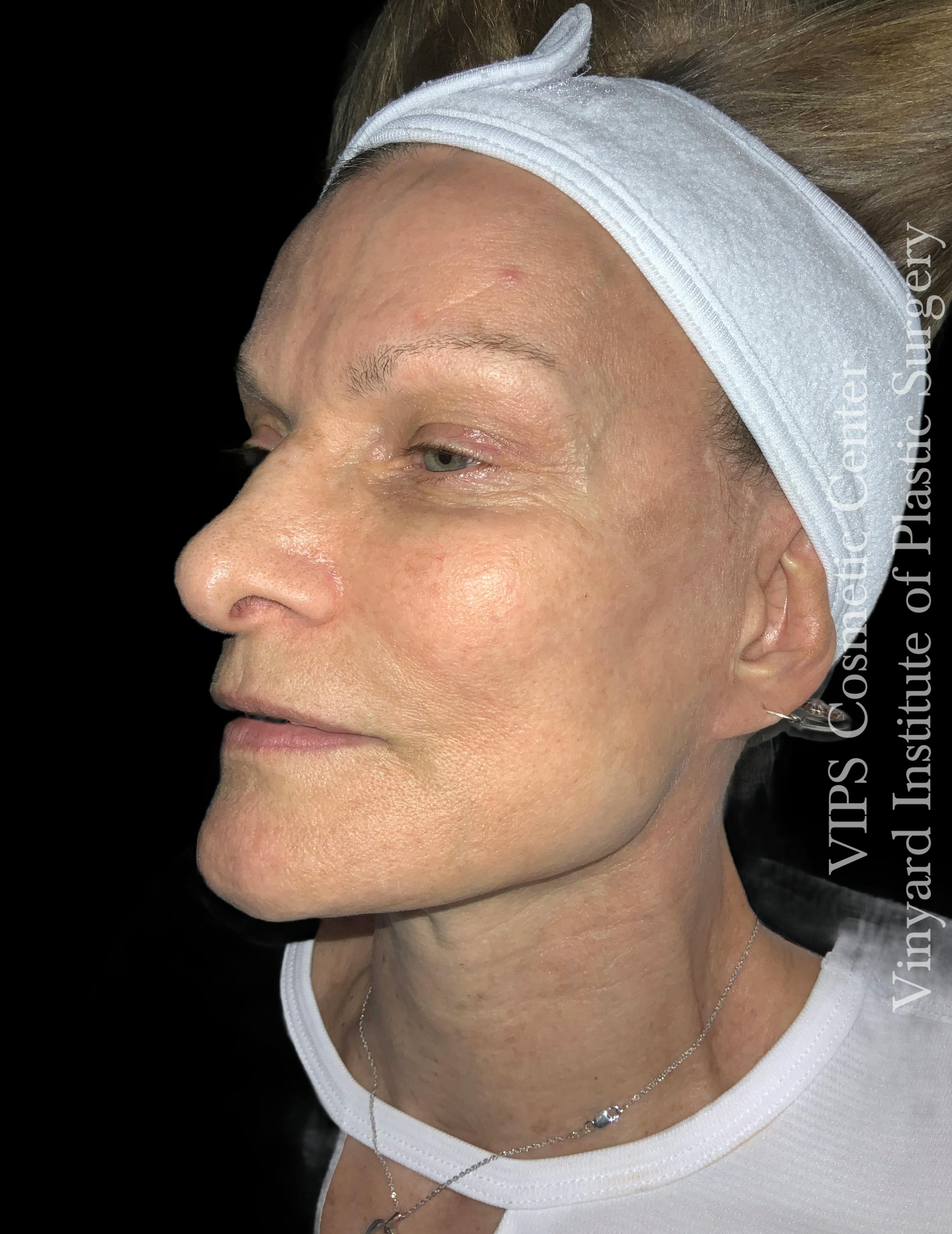 skin brightening