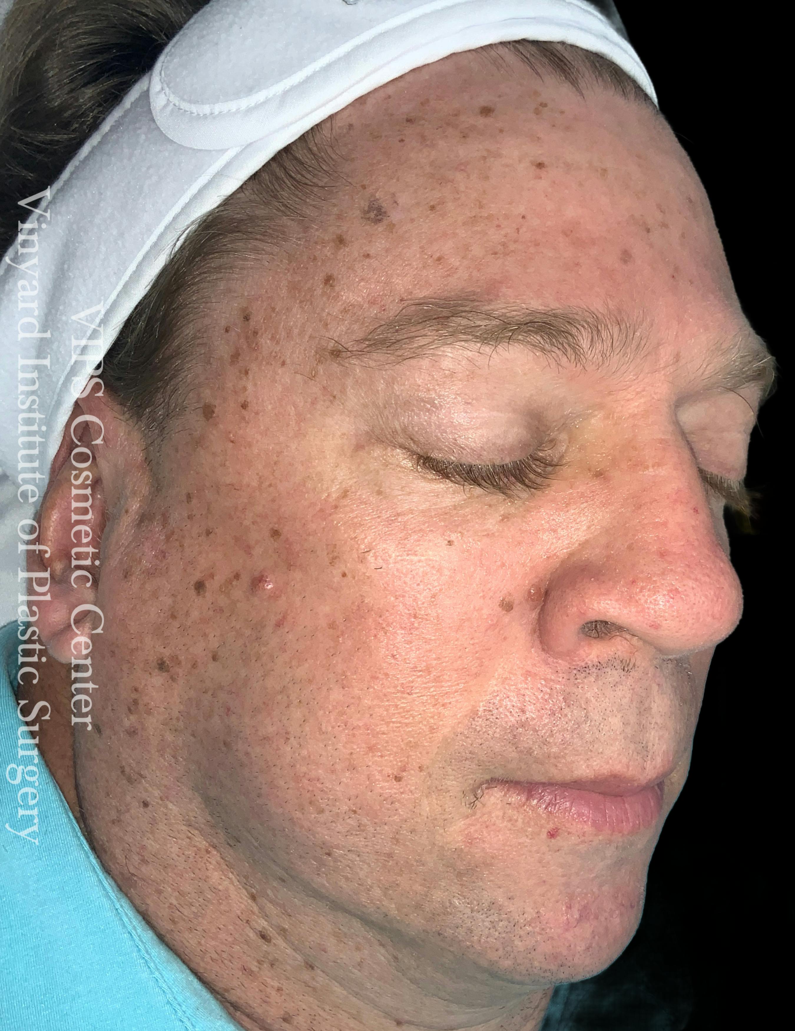 skin brightening