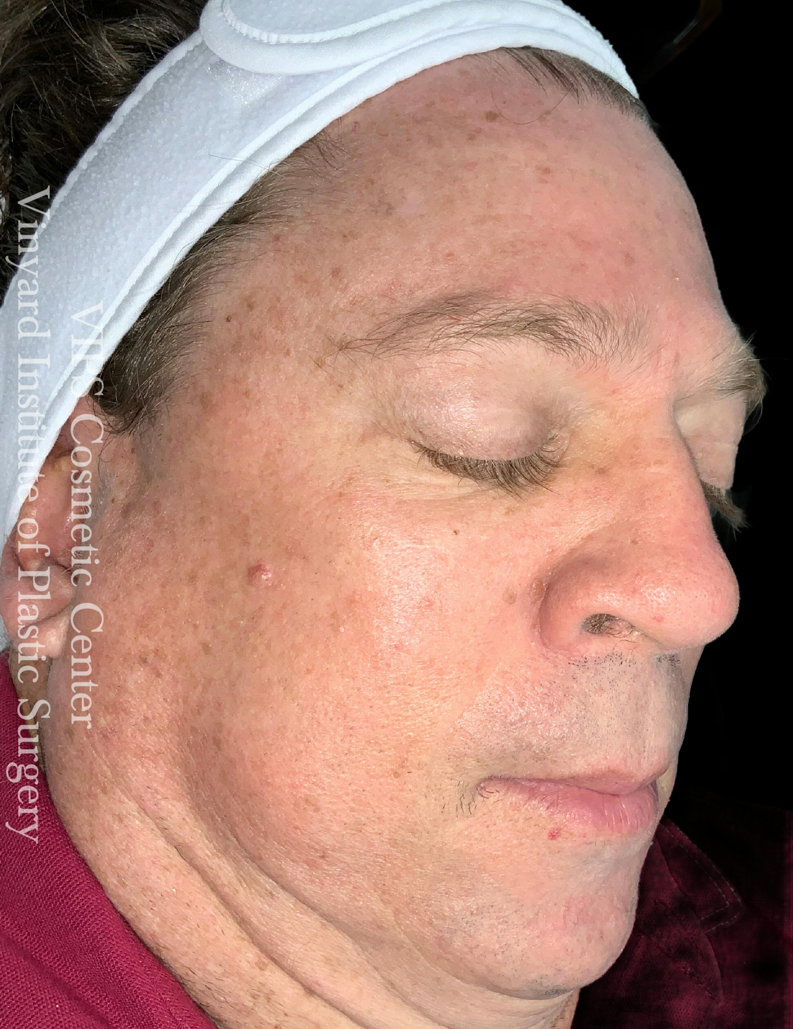 skin brightening