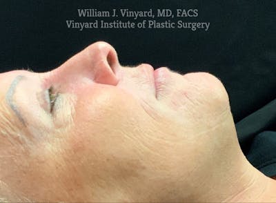 Laser Skin Resurfacing Before & After Gallery - Patient 269598 - Image 2