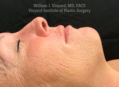 Laser Skin Resurfacing Before & After Gallery - Patient 269598 - Image 1