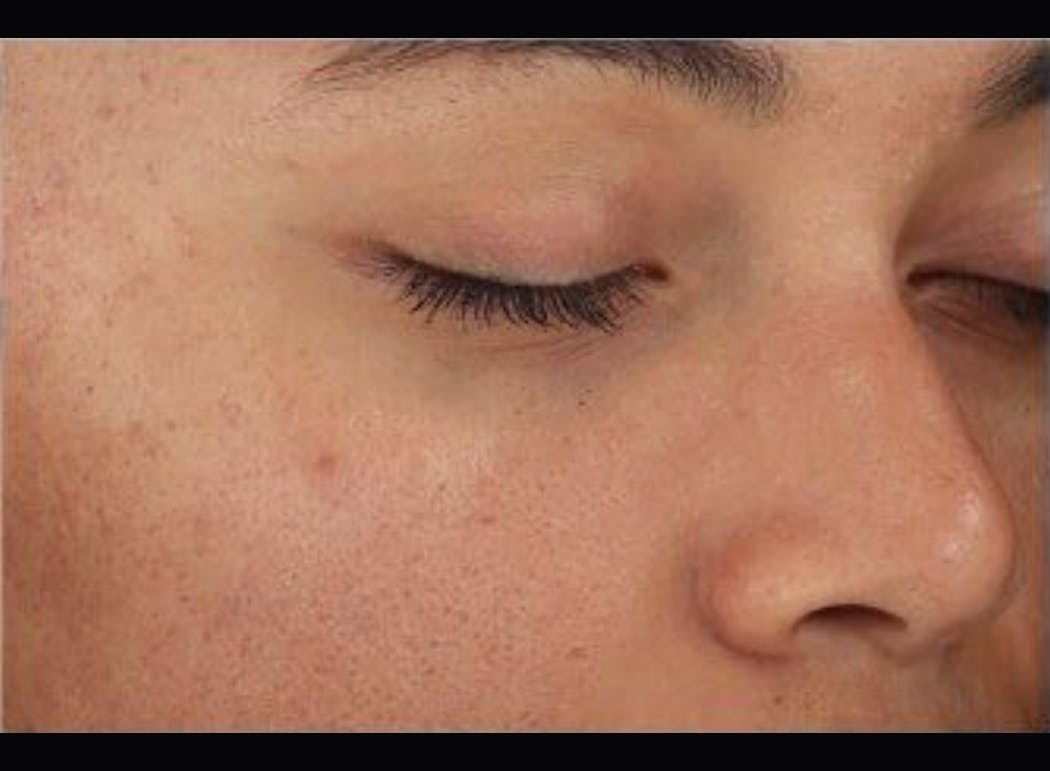 DiamondGlow treatment