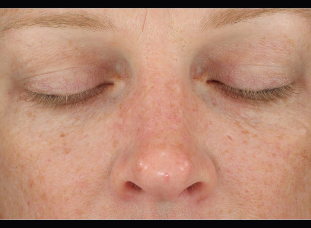 DiamondGlow treatment