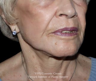 Laser Skin Resurfacing Before & After Gallery - Patient 128161 - Image 4