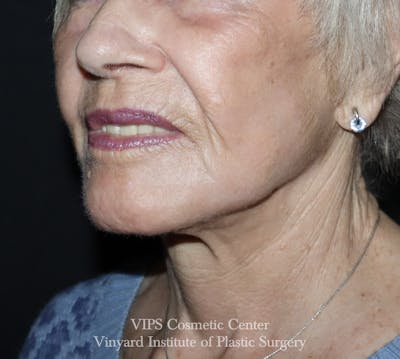 Laser Skin Resurfacing Before & After Gallery - Patient 128161 - Image 2