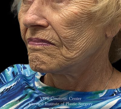 Laser Skin Resurfacing Before & After Gallery - Patient 128161 - Image 1