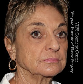 Laser Skin Resurfacing Before & After Gallery - Patient 183505 - Image 4