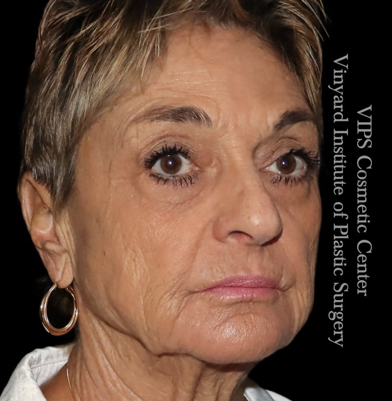 Laser Skin Resurfacing Before & After Gallery - Patient 183505 - Image 4