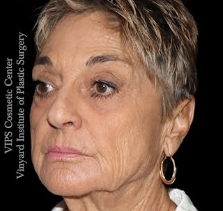 Laser Skin Resurfacing Before & After Gallery - Patient 183505 - Image 6