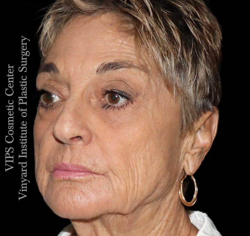 Laser Skin Resurfacing Before & After Gallery - Patient 183505 - Image 6