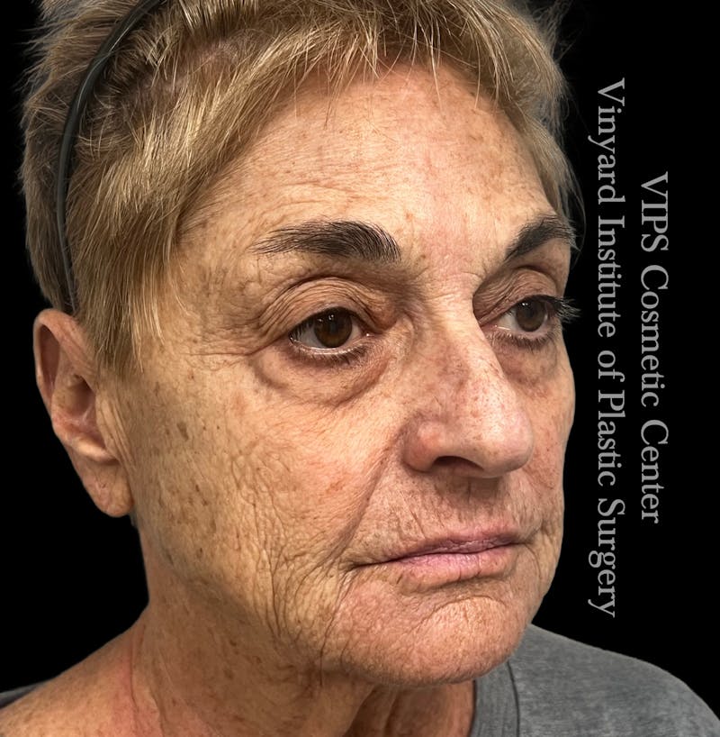 Laser Skin Resurfacing Before & After Gallery - Patient 183505 - Image 3