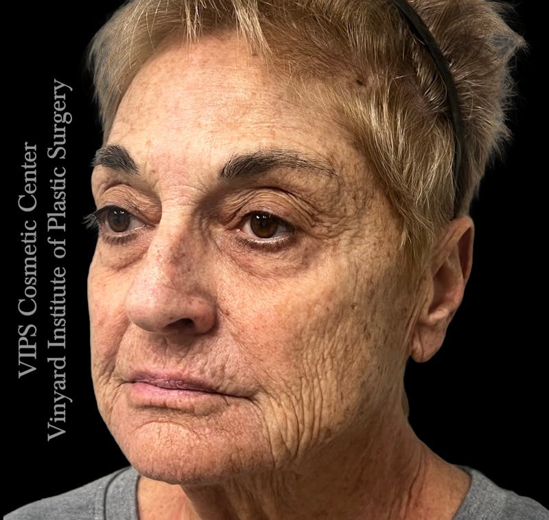 Laser Skin Resurfacing Before & After Gallery - Patient 183505 - Image 5