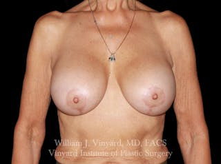 Breast Implant Exchange Before & After Gallery - Patient 201240 - Image 2