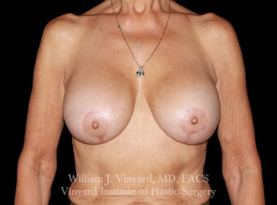 Breast Implant Exchange Before & After Gallery - Patient 201240 - Image 2