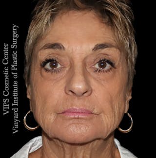 Laser Skin Resurfacing Before & After Gallery - Patient 183505 - Image 2