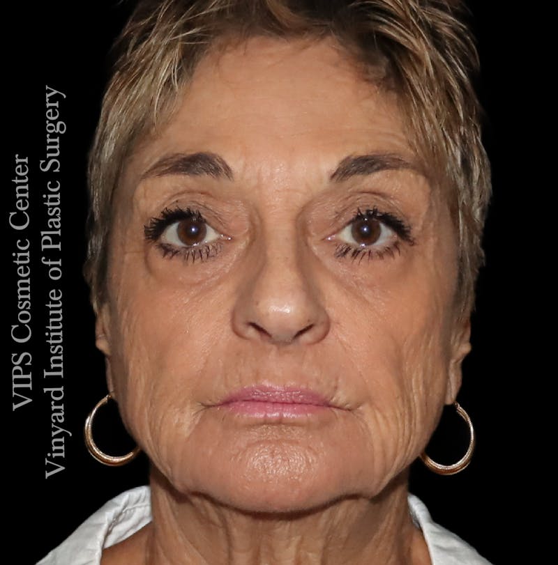 Laser Skin Resurfacing Before & After Gallery - Patient 183505 - Image 2