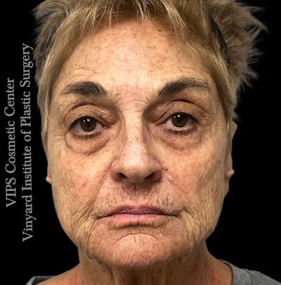 Laser Skin Resurfacing Before & After Gallery - Patient 183505 - Image 1