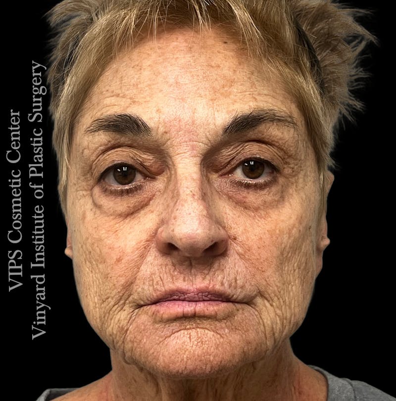 Laser Skin Resurfacing Before & After Gallery - Patient 183505 - Image 1