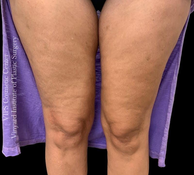 Morpheus8 BODY RF Microneedling Before & After Gallery - Patient 140160 - Image 1