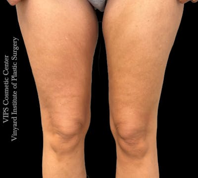 Morpheus8 BODY RF Microneedling Before & After Gallery - Patient 140160 - Image 2