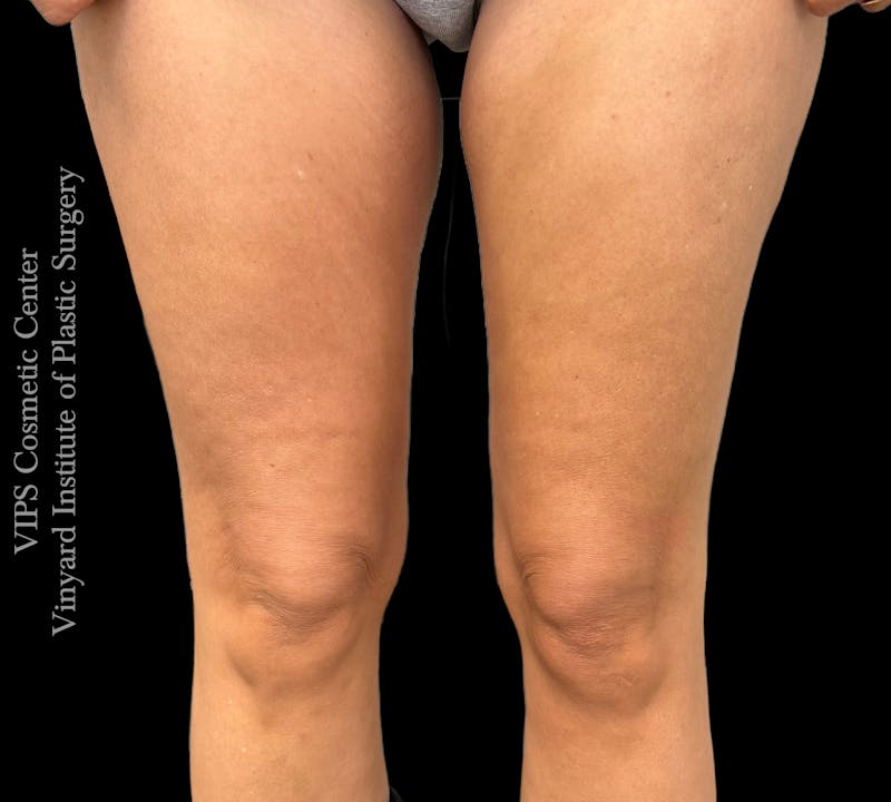 Morpheus8 BODY RF Microneedling Before & After Gallery - Patient 140160 - Image 2