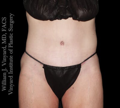 Tummy Tuck Before & After Gallery - Patient 110876 - Image 2