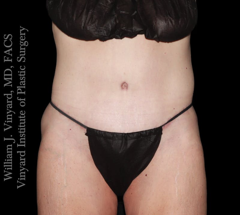 Tummy Tuck Before & After Gallery - Patient 110876 - Image 2