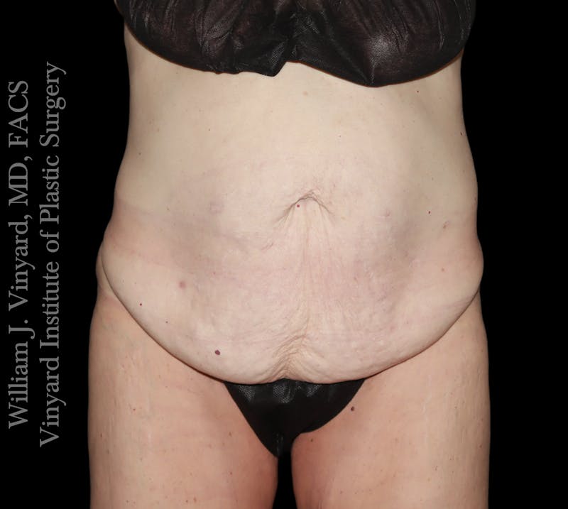 Tummy Tuck Before & After Gallery - Patient 110876 - Image 1