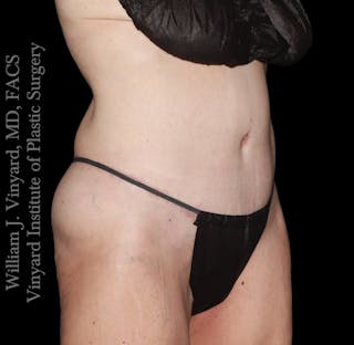 Tummy Tuck Before & After Gallery - Patient 110876 - Image 4