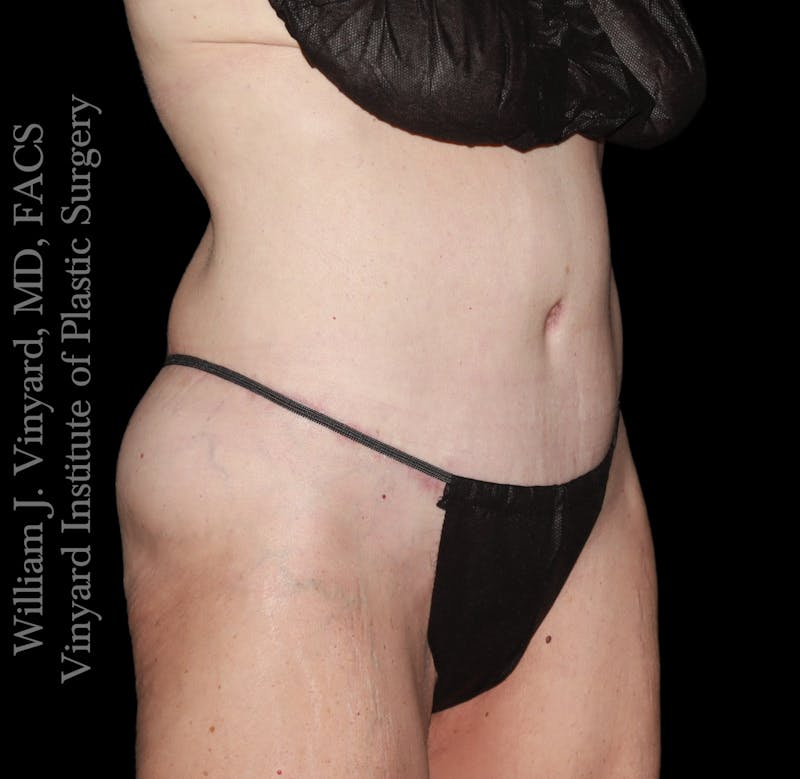 Tummy Tuck Before & After Gallery - Patient 110876 - Image 4