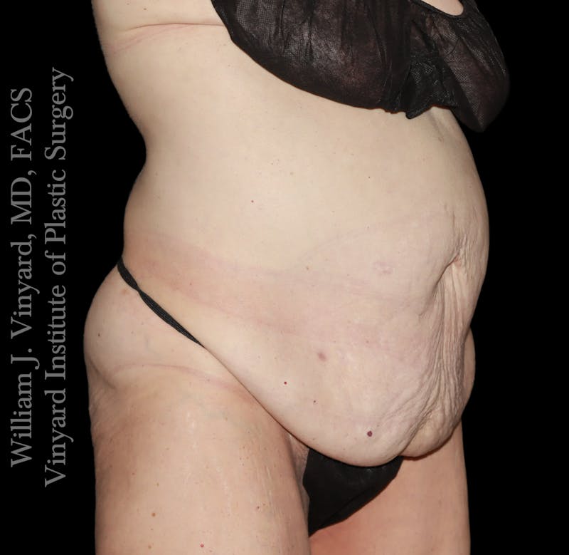 Tummy Tuck Before & After Gallery - Patient 110876 - Image 3