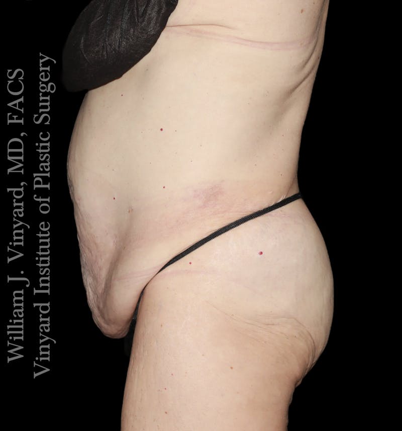 Tummy Tuck Before & After Gallery - Patient 110876 - Image 5