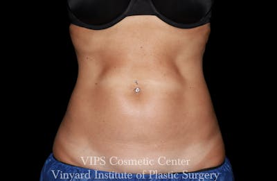 Morpheus8 BODY RF Microneedling Before & After Gallery - Patient 144834 - Image 2