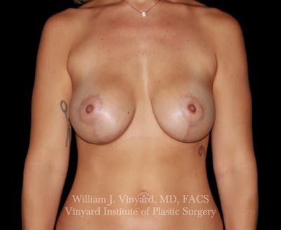 Breast Implant Exchange Before & After Gallery - Patient 350960 - Image 2