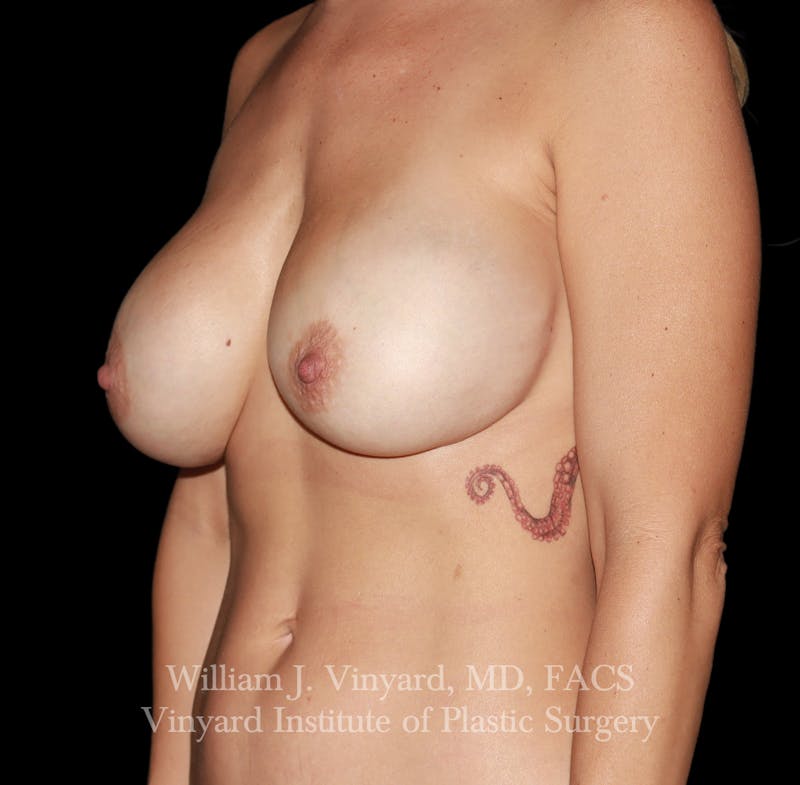 Breast Implant Exchange Before & After Gallery - Patient 350960 - Image 9