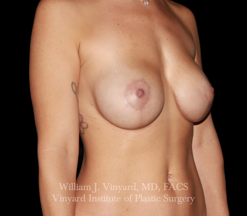 Breast Implant Exchange Before & After Gallery - Patient 350960 - Image 4