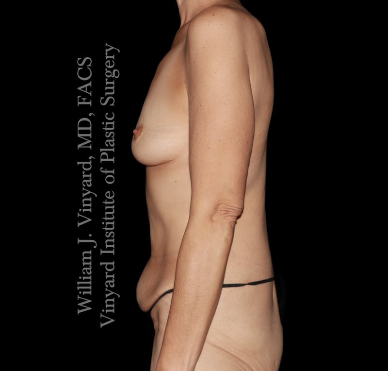 Mommy Makeover Before & After Gallery - Patient 223689 - Image 5