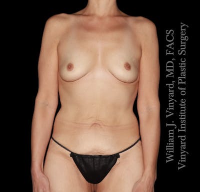 Mommy Makeover Before & After Gallery - Patient 223689 - Image 1