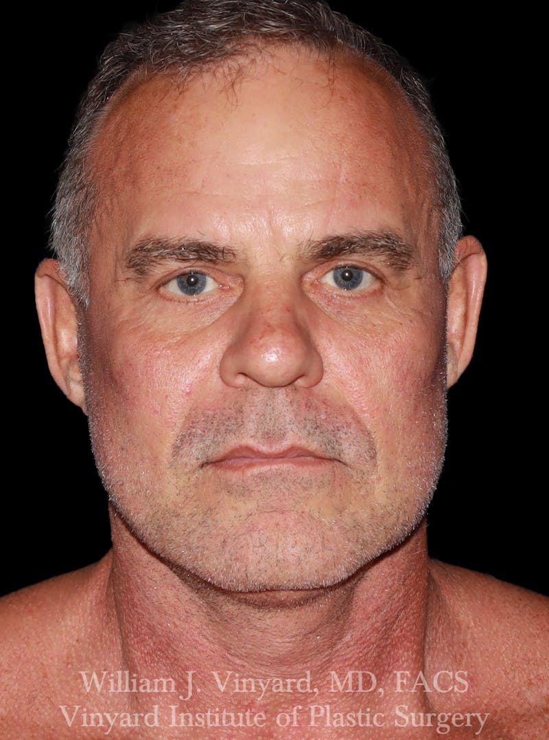 Facelift Before & After Gallery - Patient 283506 - Image 2
