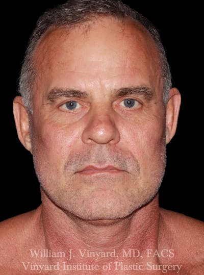 Eyelid Before & After Gallery - Patient 287766 - Image 2