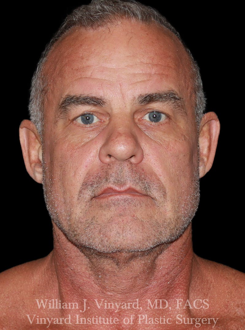 Facelift Before & After Gallery - Patient 283506 - Image 1