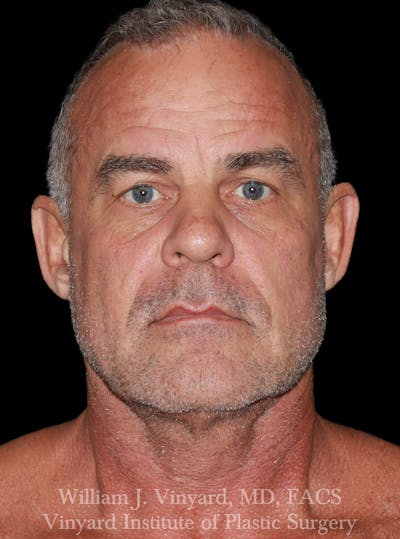 Eyelid Before & After Gallery - Patient 287766 - Image 1