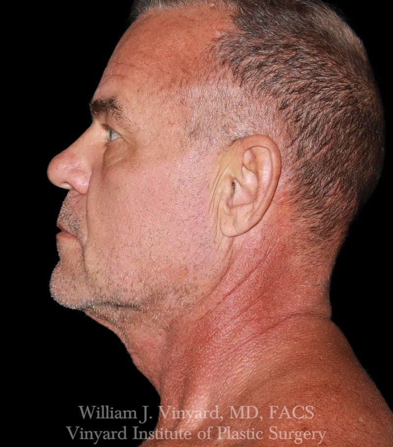 Facelift Before & After Gallery - Patient 283506 - Image 5
