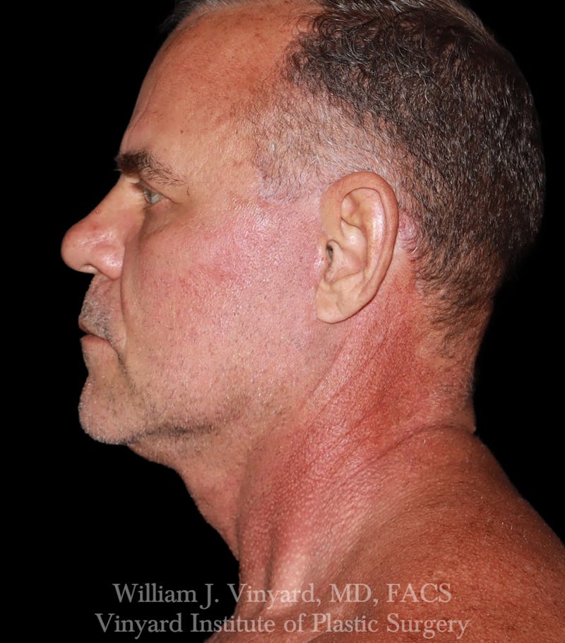Facelift Before & After Gallery - Patient 283506 - Image 6