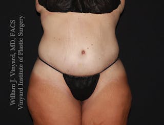 Tummy Tuck Before & After Gallery - Patient 177377 - Image 2